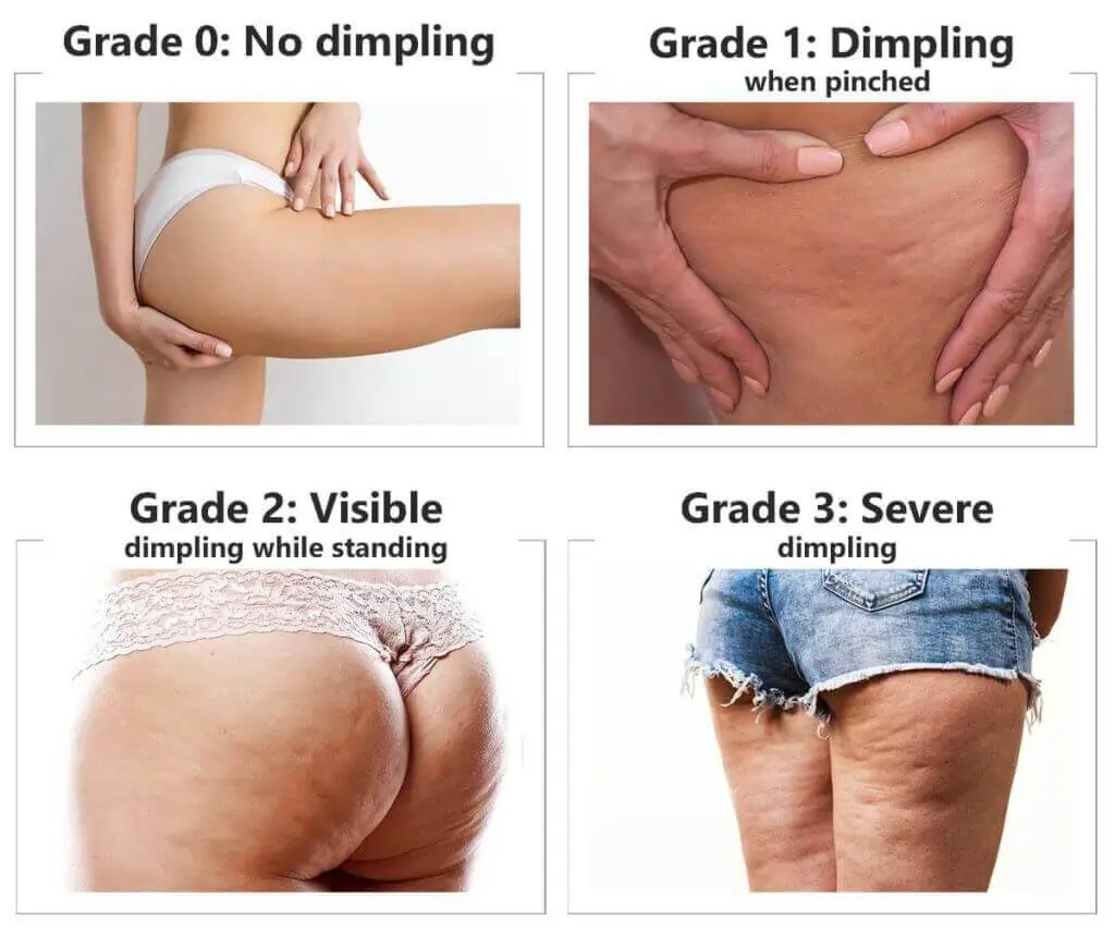 Representation of the stages of cellulite development West Sussex